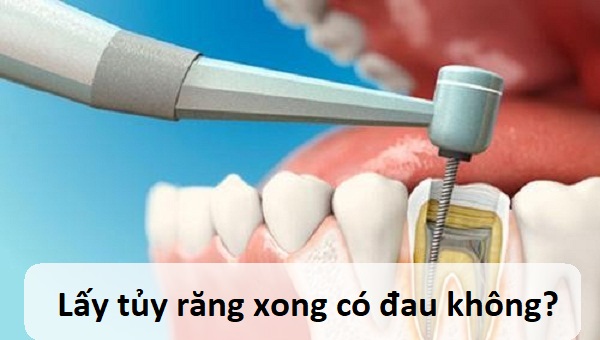 lấy tủy răng xong bị đau, lấy tuỷ răng xong có bị đau không, sau khi lấy tủy răng có đau không, triệu chứng sau khi lấy tuỷ răng