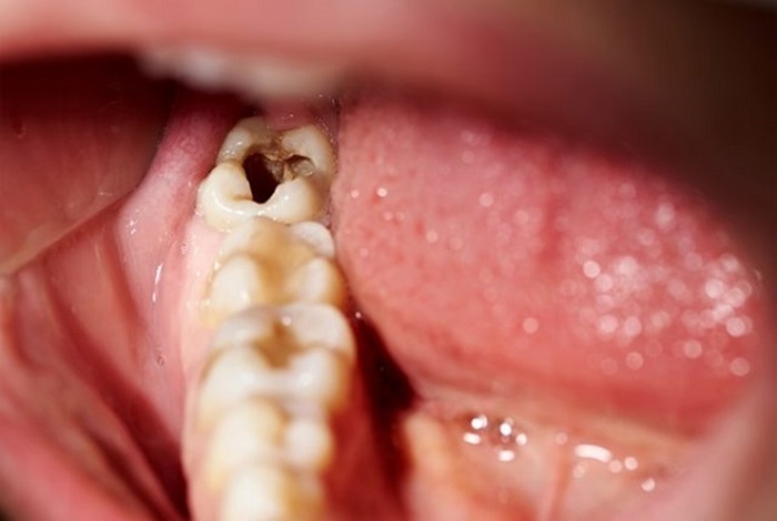 mọc răng khôn hàm dưới bên phải, mọc răng khôn hàm dưới bên phải có sao không, mọc răng khôn hàm dưới bên phải bị đau, mọc răng khôn hàm dưới bên phải đau, mọc răng khôn hàm dưới bên phải bị sưng lợi, mọc răng khôn hàm dưới bên phải