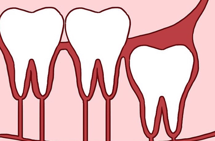 mọc răng khôn hàm dưới bên phải, mọc răng khôn hàm dưới bên phải đau,mọc răng khôn hàm dưới bên phải có sao không