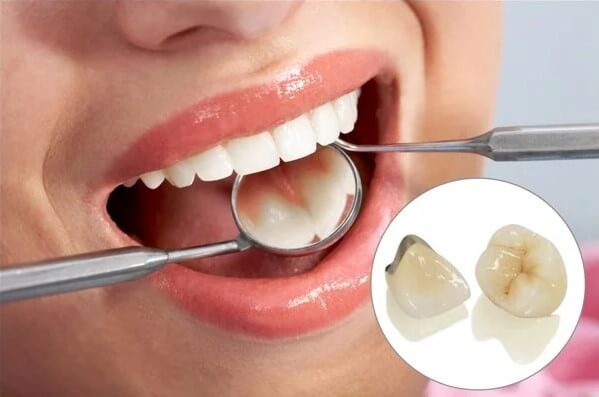 bọc răng sứ loại nào tốt, bọc răng sứ loại nào là tốt nhất, bọc răng sứ loại nào đẹp nhất, bọc răng sứ loại nào, nên bọc răng sứ loại nào, nên bọc răng sứ loại nào tốt, nên bọc răng sứ loại nào webtretho, 