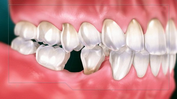 răng 46, nhổ răng 46 có nguy hiểm không, nhổ răng 46, răng 46 là răng nào, răng 46 47, răng số 46