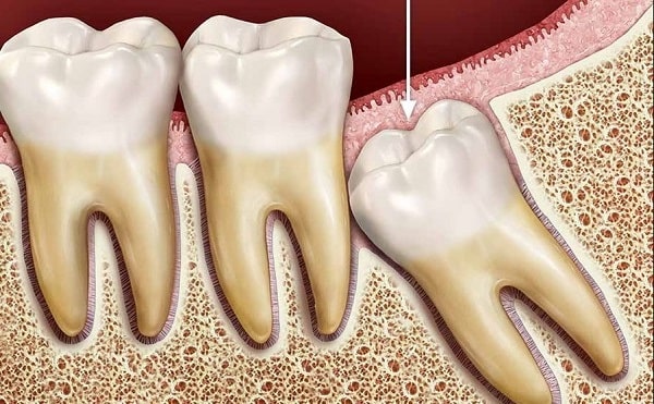 răng số 38 là răng gì, răng số 38, răng số 38 mọc lệch, răng số 38 là răng nào, nhổ răng số 38 hết bao nhiêu tiền, nhổ răng số 38, răng khôn số 38, vị trí răng số 38, nhổ răng khôn số 38