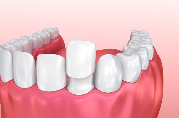 chữa tủy bọc sứ, chữa tủy bọc răng sứ, điều trị tủy răng bọc sứ, răng chữa tủy có bọc sứ được không
