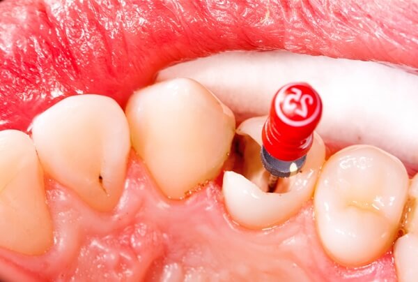 chữa tủy bọc sứ, chữa tủy bọc răng sứ, điều trị tủy răng bọc sứ, răng chữa tủy có bọc sứ được không