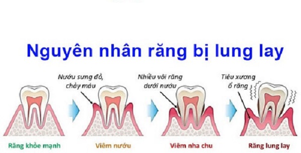 răng số 6 bị lung lay, răng hàm số 6 bị lung lay, răng hàm số 6 lung lay, răng số 6 lung lay
