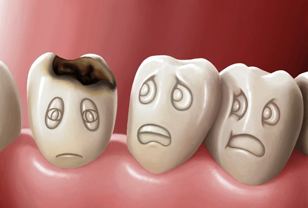 răng sâu không nhổ có sao không, răng sâu không nhổ ảnh hưởng gì, răng sâu không nhổ, răng sâu lâu ngày không nhổ, răng sâu có nên nhổ không, tác hại của răng sâu không nhổ, nhổ răng sâu không đau, cách nhổ răng sâu không đau, răng sâu nặng có nên nhổ không, cách nhổ răng sâu không đau tại nhà