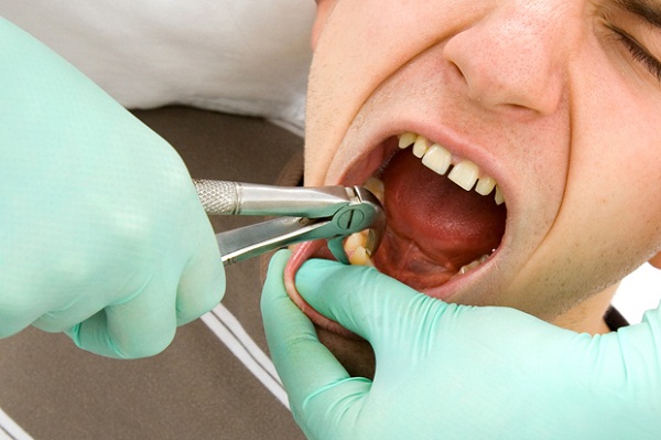 sâu răng hàm trên, sâu răng hàm trên có nên nhổ, sâu răng hàm trên trong cùng, sâu răng hàm trên cùng, bị sâu răng hàm trên, chữa sâu răng hàm trên, răng hàm sâu có nên nhổ, nhổ răng hàm trên trong cùng bị sâu, nhổ răng sâu trong cùng hàm trên