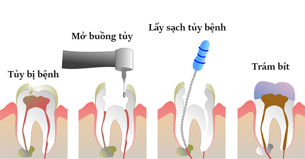 tại sao phải lấy tủy răng, tại sao phải lấy tủy răng nhiều lần, vì sao phải lấy tủy răng
