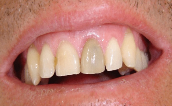 triệu chứng sau khi lấy tủy răng