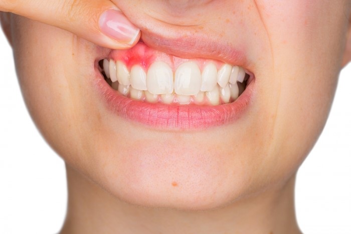 triệu chứng sau khi lấy tủy răng