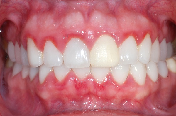 triệu chứng viêm nướu răng, triệu chứng viêm nướu răng ở trẻ em, triệu chứng của viêm nướu răng, triệu chứng viêm răng lợi, các triệu chứng viêm nướu răng