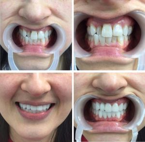 niềng răng làm thay đổi khuôn mặt, lột xác sau khi niềng răng, khuôn mặt trước và sau khi niềng răng, niềng răng thay đổi góc nghiêng, niềng răng thay đổi khuôn mặt như thế nào, niềng răng có làm thay đổi khuôn mặt không, niềng răng có thay đổi khuôn mặt không, thay đổi sau niềng răng, niềng răng có thay đổi khuôn mặt, niềng răng hô có làm thay đổi khuôn mặt, khuôn mặt thay đổi sau khi niềng răng, thay đổi sau khi niềng răng, niềng răng thay đổi xương hàm, sự thay đổi sau khi niềng răng, niềng răng có làm mặt nhỏ lại, niềng răng thay đổi như thế nào, niềng răng thay đổi, niềng răng có thay đổi xương hàm, thay đổi khi niềng răng, góc nghiêng trước và sau khi niềng răng, niềng răng trước và sau, niềng răng làm mặt dài ra, niềng răng giúp mặt thon gọn, niềng răng làm nhỏ mặt, niềng răng có giúp mặt thon gọn, thay đổi nhờ niềng răng, sự thay đổi khi niềng răng, niềng răng giúp thay đổi khuôn mặt, nieng rang co thay doi khuon mat ko, niềng răng thay đổi khuôn hàm, truoc va sau khi nieng rang, quá trình thay đổi khi niềng răng, nieng rang truoc va sau