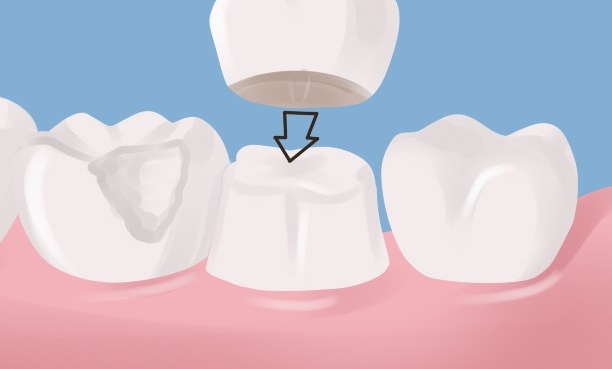 bọc răng sứ có ảnh hưởng gì không, bọc răng sứ thẩm mỹ có ảnh hưởng gì không, bọc răng sứ có tốt không, bọc răng sứ có ảnh hưởng gì không, bọc răng sứ có an toàn không, bọc răng sứ có ảnh hưởng đến sức khoẻ không