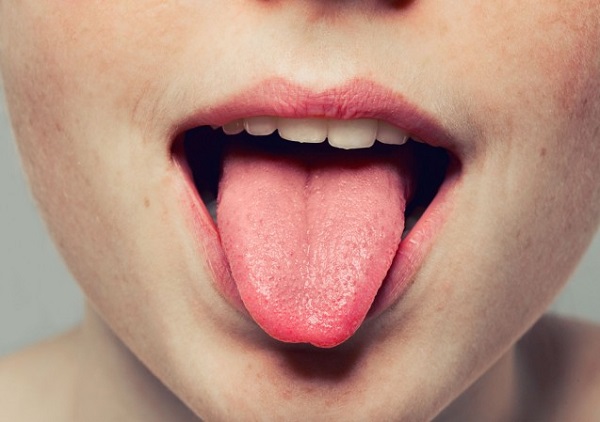cách điều trị tưa lưỡi ở người lớn