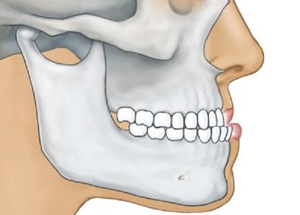 mọc răng khôn đau xương hàm