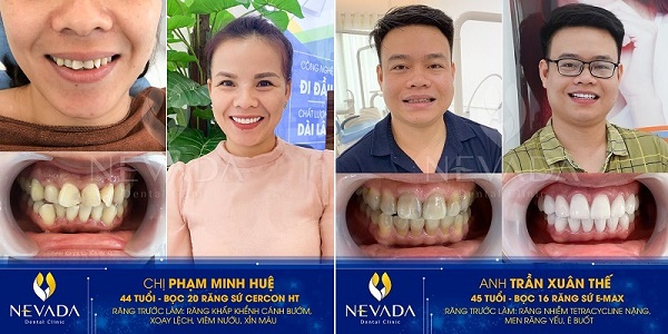 răng inox có tốt không, răng inox là gì, răng inox, bọc răng inox, niềng răng inox đơn giản, bọc răng inox bao nhiêu tiền, răng sứ inox