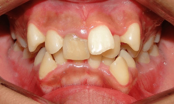 trẻ thay răng mọc lệch, bé thay răng mọc lệch, bé thay răng mọc lệch phải làm sao, trẻ thay răng bị mọc lệch, bé thay răng sữa mọc lệch, trẻ thay răng sữa bị mọc lệch, 