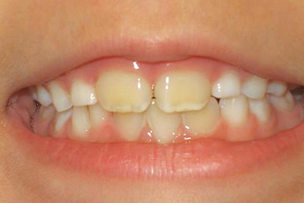 cách chữa răng ố vàng cho bé hiệu quả