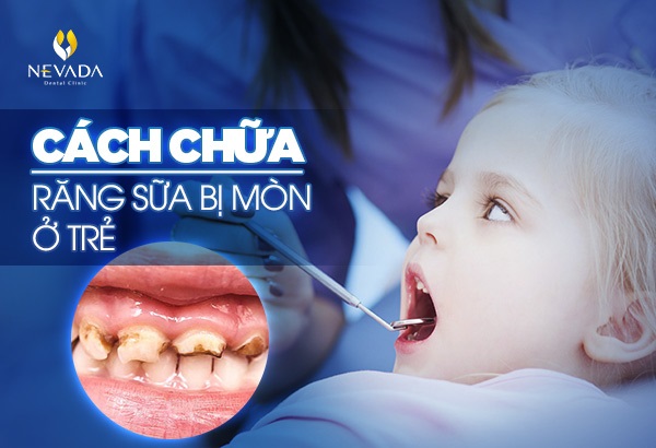 cách chữa răng sữa bị mòn, răng sữa của trẻ bị mòn, răng sữa trẻ em bị mòn, cách khắc phục răng sữa bị mòn