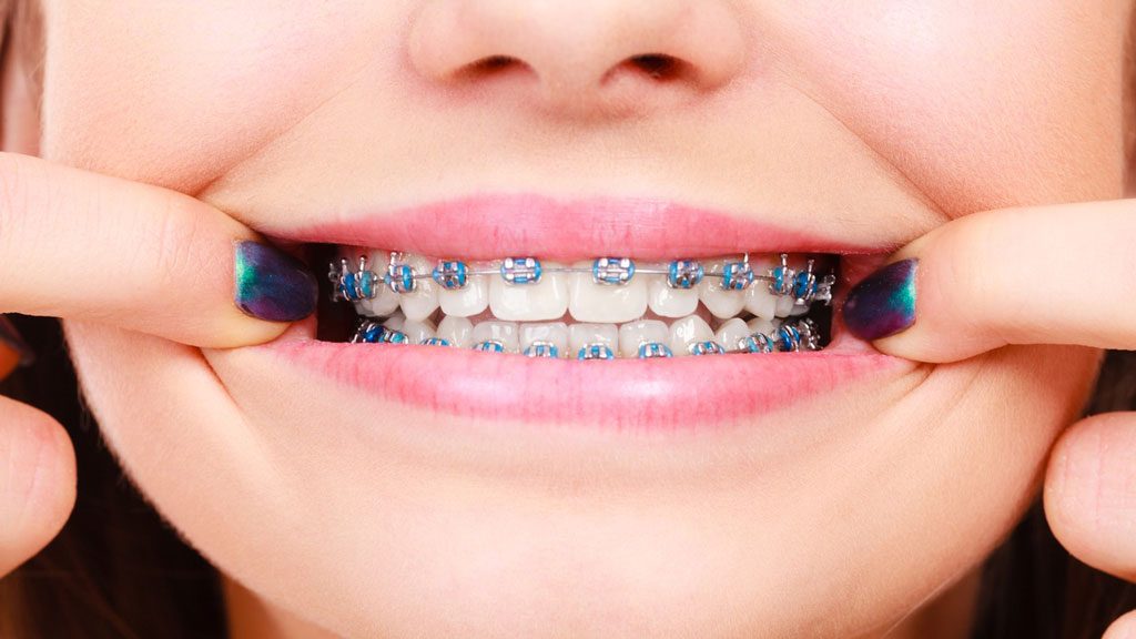 cách làm răng đều đẹp tại nhà, cách làm răng đều đẹp, cách làm răng đều và đẹp