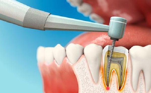 Đặt thuốc diệt tủy răng bị đau nhức