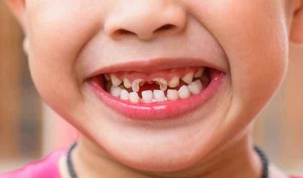 Hiện tượng mòn răng ở trẻ em