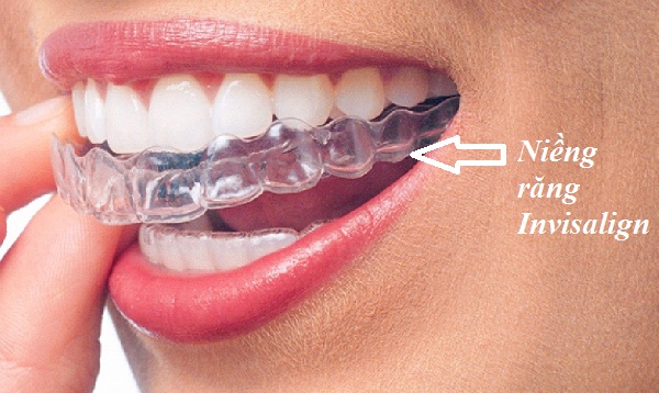 răng càng ngày càng thưa, răng cửa càng ngày càng thưa, tại sao răng càng ngày càng thưa, vì sao răng càng ngày càng thưa