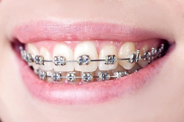 răng càng ngày càng thưa, răng cửa càng ngày càng thưa, tại sao răng càng ngày càng thưa, vì sao răng càng ngày càng thưa