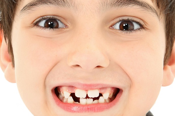 Niềng răng cho trẻ 8 tuổi, niềng răng cho bé 8 tuổi, 8 tuổi niềng răng không , trẻ 8 tuổi có nên niềng răng không, niềng răng cho trẻ 8 tuổi bao nhiêu tiền