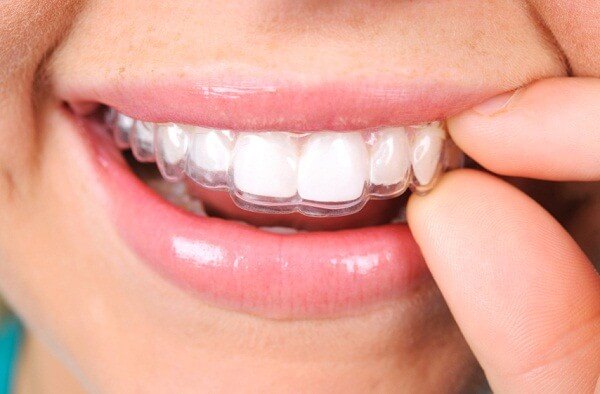 niềng răng không mắc cài d-aligner, niềng răng không mắc cài thẩm mỹ d-aligner