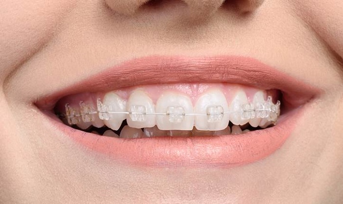 niềng răng composite, niềng răng mắc cài composite, quy trình niềng răng mắc cài composite, quy trình niềng răng composite, niềng răng composite có tốt không, niềng răng composite là gì, niềng răng mắc cài composite có tốt không, niềng răng mắc cài composite là gì, Địa chỉ niềng răng mắc cài Composite, Địa chỉ niềng răng Composite