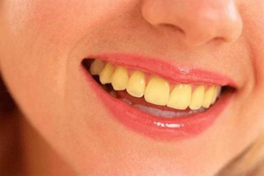 Răng sứ có đổi màu không, răng sứ bị đổi màu, răng sứ có bị đổi màu không, đổi màu răng sứ
