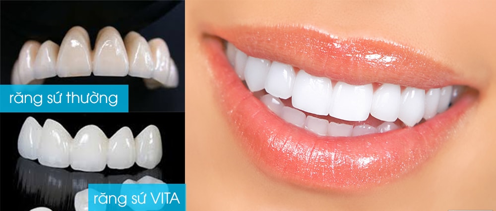 Răng sứ titan vita có tốt không, răng sứ titan vita giá bao nhiêu, răng sứ titan vita là gì, răng sứ titan vita, răng sứ titan và titan vita