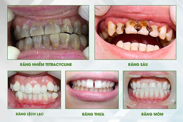 so sánh răng sứ kim loại và răng toàn sứ, răng sứ kim loại và răng toàn sứ, răng toàn sứ và răng sứ kim loại