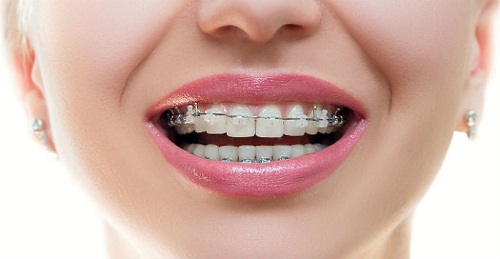  niềng răng ảnh hưởng thần kinh, niềng răng có ảnh hưởng thần kinh, niềng răng có ảnh hưởng đến thần kinh, niềng răng có ảnh hưởng đến thần kinh không