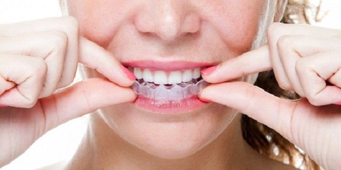  niềng răng ảnh hưởng thần kinh, niềng răng có ảnh hưởng thần kinh, niềng răng có ảnh hưởng đến thần kinh, niềng răng có ảnh hưởng đến thần kinh không