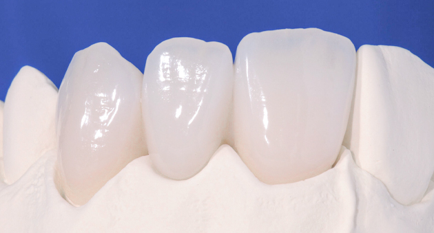 so sánh răng sứ Emax và Cercon