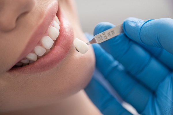 bọc răng sứ kim loại thường có tốt không, Bọc răng sứ kim loại có tốt không, Bọc răng sứ kim loại giá bao nhiêu