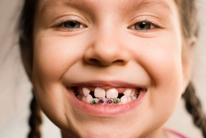 niềng răng cho trẻ 7 tuổi, niềng răng cho bé 7 tuổi