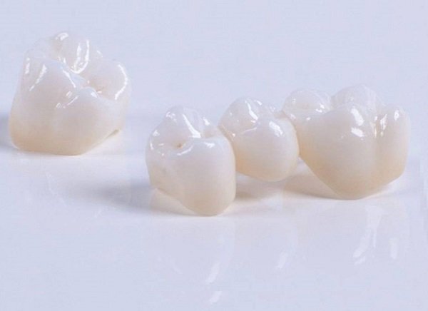 răng sứ emax press giá bao nhiêu, giá răng sứ emax press, Chi phí bọc răng sứ Emax press
