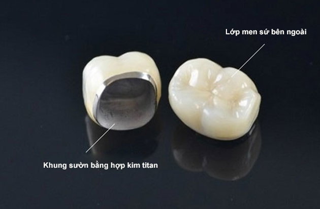 răng sứ mỹ là gì