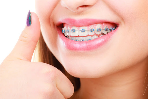 sau khi niềng răng có nên tẩy trắng răng, Tẩy trắng răng sau khi niềng, niềng răng xong có nên tẩy trắng răng
