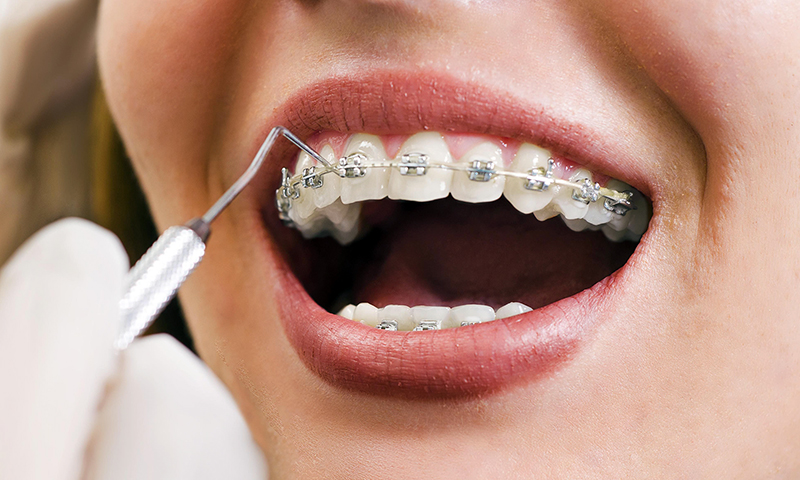 sau khi niềng răng có nên tẩy trắng răng, Tẩy trắng răng sau khi niềng, niềng răng xong có nên tẩy trắng răng