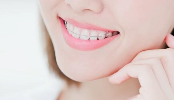 sau khi niềng răng phải đeo hàm duy trì bao lâu, sau khi niềng răng đeo hàm duy trì, sau niềng răng phải đeo hàm duy trì bao lâu, sau khi niềng răng đeo hàm duy trì bao lâu, sau khi niềng răng đeo hàm duy trì, niềng răng xong phải đeo hàm duy trì bao lâu