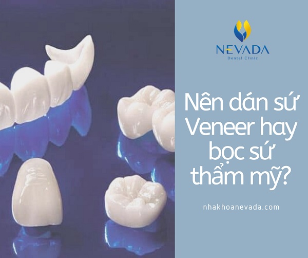 So sánh dán sứ Veneer và bọc răng sứ thẩm mỹ