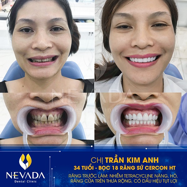 So sánh răng sứ Cercon ht và Zirconia, răng sứ Cercon ht và Zirconia