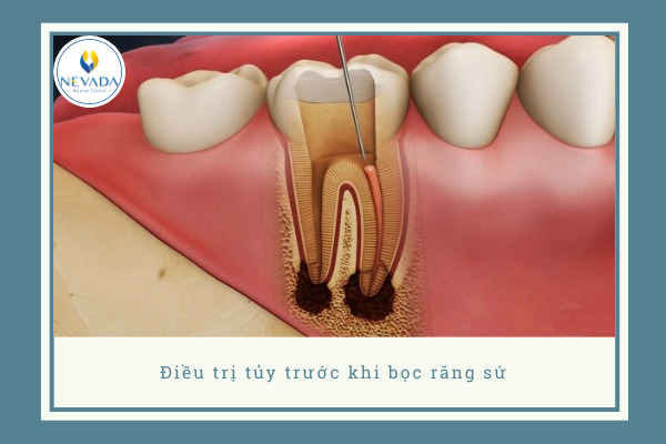 bọc răng sứ sau khi lấy tủy bao nhiêu tiền, bọc răng sứ cho răng đã lấy tủy bao nhiêu tiền, Lấy tủy bọc răng sứ giá bao nhiêu, giá bọc răng sứ sau khi lấy tủy, giá bọc răng sứ cho răng sau lấy tuỷ bao nhiêu tiền 
