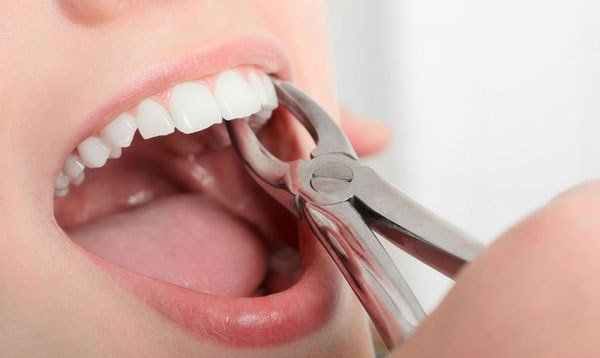 làm cách nào để cầm máu sau khi nhổ răng, cách cầm máu sau khi nhổ răng khôn, cách cầm máu sau khi nhổ răng hàm, cách cầm máu sau khi nhổ răng cấm, cách cầm máu sau khi nhổ răng số 8, cách cầm máu nhanh sau khi nhổ răng, làm cách nào để cầm máu sau khi nhổ răng, cầm máu sau khi nhổ răng khôn, cầm máu sau khi nhổ răng hàm, cầm máu sau khi nhổ răng, mẹo cầm máu sau khi nhổ răng, cách cầm máu sau khi nhổ răng, thuốc cầm máu sau khi nhổ răng, làm sao cầm máu sau khi nhổ răng