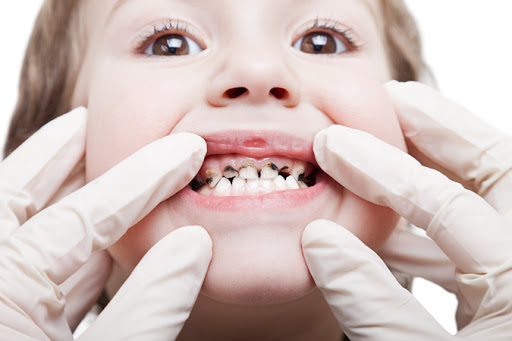 nguyên nhân trẻ bị mủn răng, hiện tượng mủn răng ở trẻ, trẻ bị mủn răng sữa, trẻ bị mủn răng, bé bị mủn răng sữa, bé bị mủn răng, trẻ con bị mủn răng, trẻ em bị mủn răng, trẻ bị mủn chân răng, nguyên nhân trẻ bị mủn răng, trẻ 1 tuổi bị mủn răng, trẻ 2 tuổi bị mủn răng, tại sao trẻ bị mủn răng, răng trẻ em bị mủn, Răng bị mủn vỡ, Răng của bé bị mủn, mủn răng sữa, mủn răng, mủn răng là gì, bệnh mủn răng
