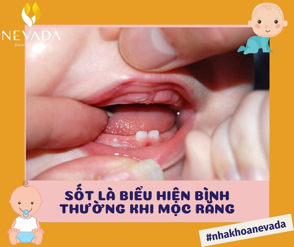 cách hạ sốt cho trẻ mọc răng, hạ sốt cho trẻ mọc răng, cách hạ sốt cho trẻ mọc răng hàm, cách chữa hạ sốt cho trẻ mọc răng, cách giảm sốt cho bé mọc răng, cách hạ sốt cho trẻ nhỏ mọc răng, hạ sốt cho trẻ mọc răng, hạ sốt cho trẻ khi mọc răng, thuốc hạ sốt cho trẻ mọc răng, hạ sốt nhanh cho trẻ mọc răng, cách hạ sốt cho bé mọc răng hàm, hạ sốt cho trẻ sơ sinh mọc răng, trẻ sốt mọc răng có nên cho uống thuốc hạ sốt